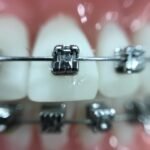 Colocación de brackets